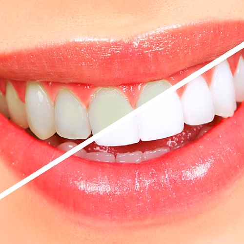 Clareamiento Dental 1