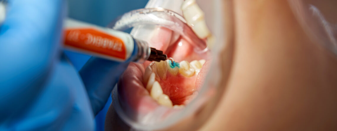 curaciones dentales