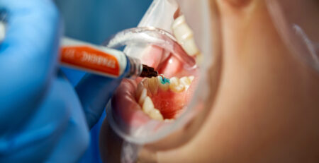 curaciones dentales