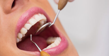 limpieza dental