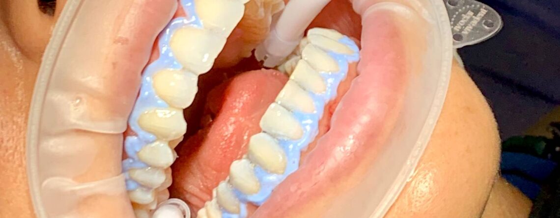 blancamiento dental