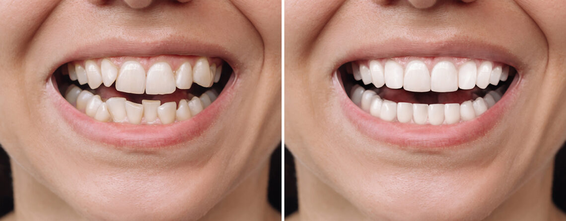 carillas dentales 