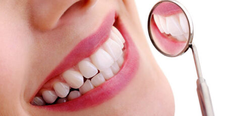 carillas-dentales.