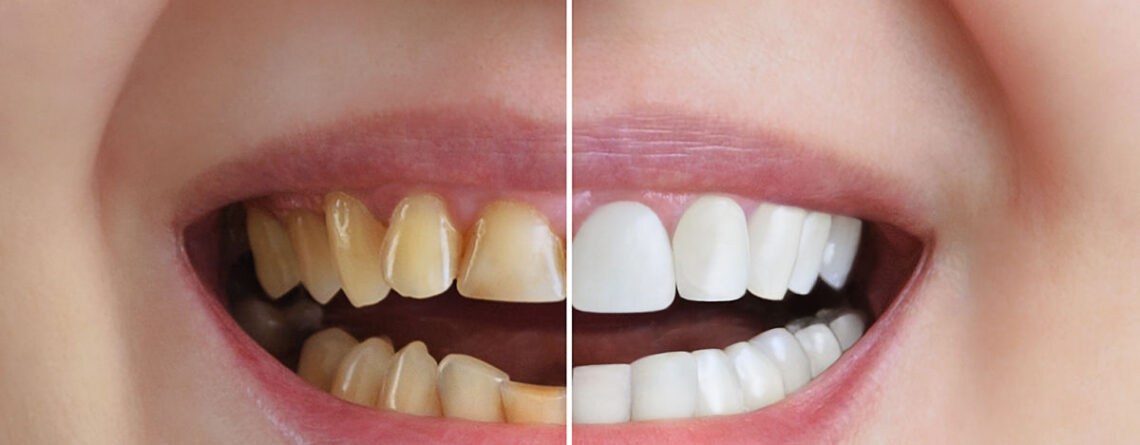 carillas dentales