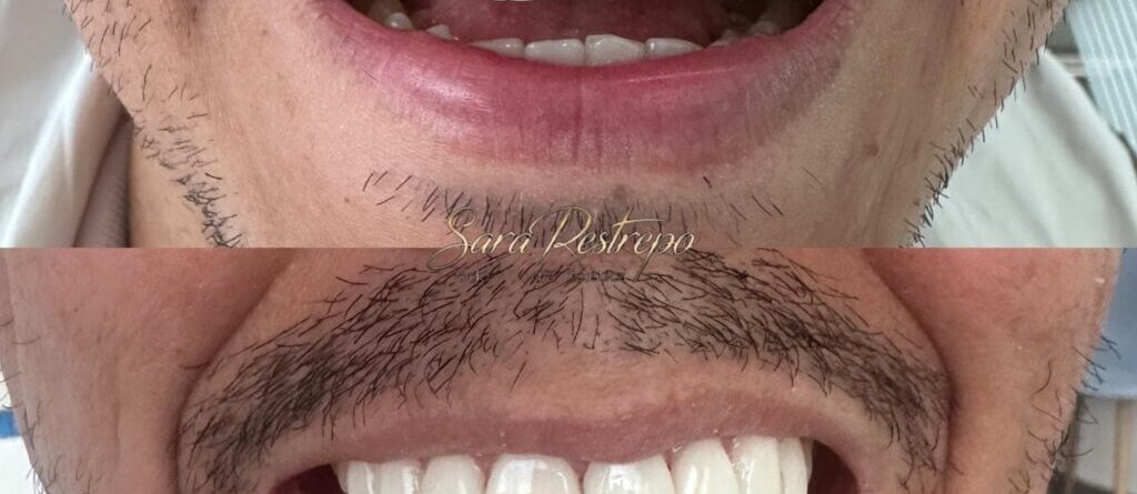  carillas dentales