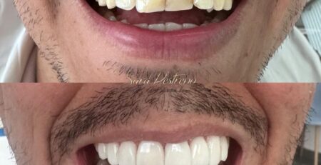  carillas dentales
