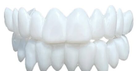 carillas dentales