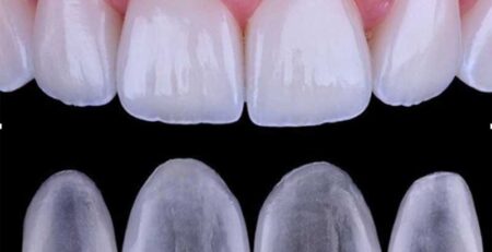 carillas dentales