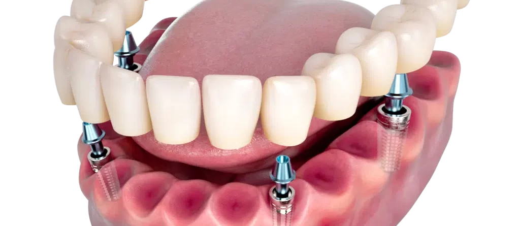 implantes dentales
