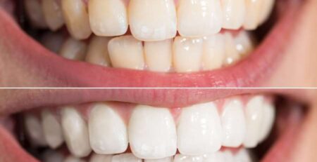 Blanqueamiento Dental