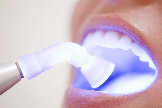 blanqueamiento dental