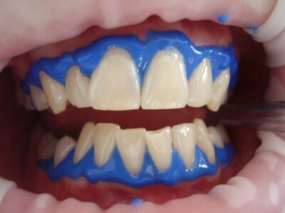 Cómo cuidar tus dientes después de un blanqueamiento dental