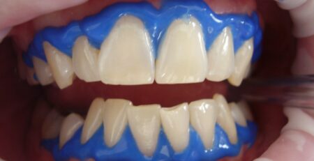 Cómo cuidar tus dientes después de un blanqueamiento dental