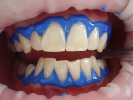 Cómo cuidar tus dientes después de un blanqueamiento dental